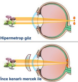 Hipermetrop - Göz Kusurları