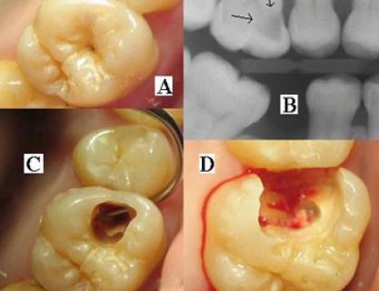 Dişlerimiz Neden Çürür?